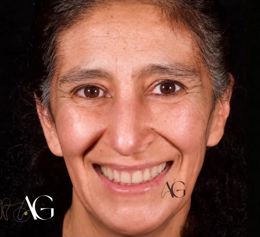 Después del tratamiento: Rehabilitación oral completa