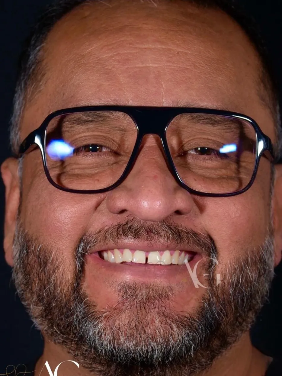 Antes del tratamiento: Rehabilitación estética superior